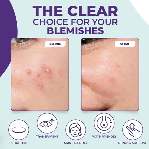 Pimple Patches for face and body | 36 Count (12mm), Invisible Hydrocolloid Acne patches – Face Stickers for Zits, dark spot , Blemishes, Pore strips, Forehead pimple patch , Invisible spot cover