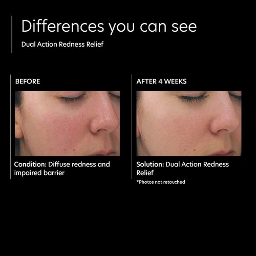 PCA SKIN Dual Action Redness Relief Serum - Soothes Redness & Inflammation with OmniSome Technology | 1 oz
