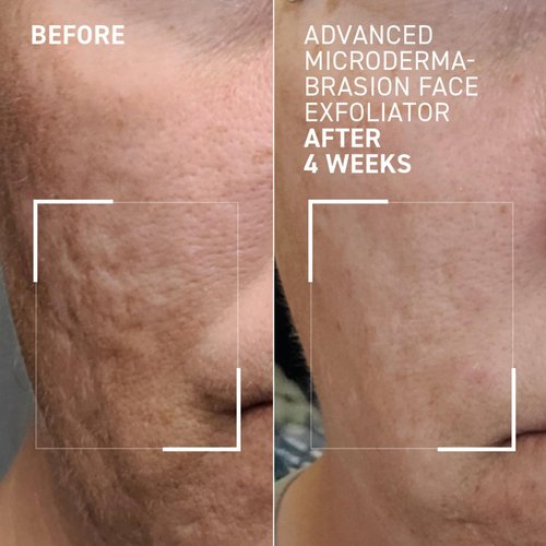 Dr. Brandt Advanced Microdermabrasion Face Exfoliator - Refines Texture, Minimizes the Look of Fine Lines & Enhances Overall Skin Tone