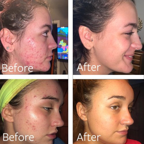 Dr. Song Benzoyl Peroxide Wash - 10% Acne Treatment Face & Body Cleanser | 8 Fl Oz