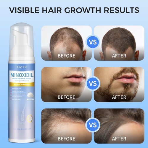 Trzsfr 5% Minoxidil Foam for Men & Women, Hair Regrowth Treatment for Thinning Hair & Beard Growth, Extra Strength Topical Foam, Clinically Proven Hair Loss Treatment, 6 Month Supply (14OZ Total)