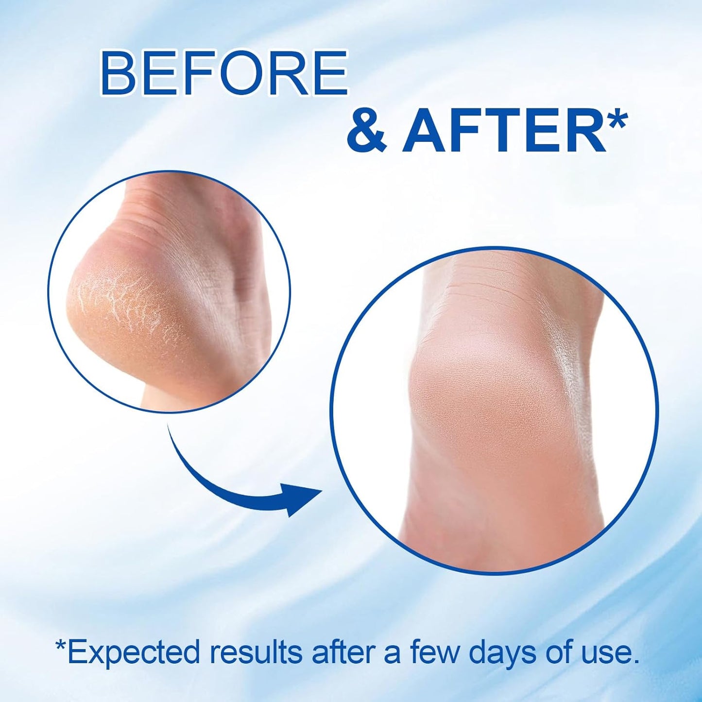 Skiennix 60% Urea Cream Stick - Maximum Strength Foot Cream with 2% Salicylic Acid | Softens Dry Cracked Heels