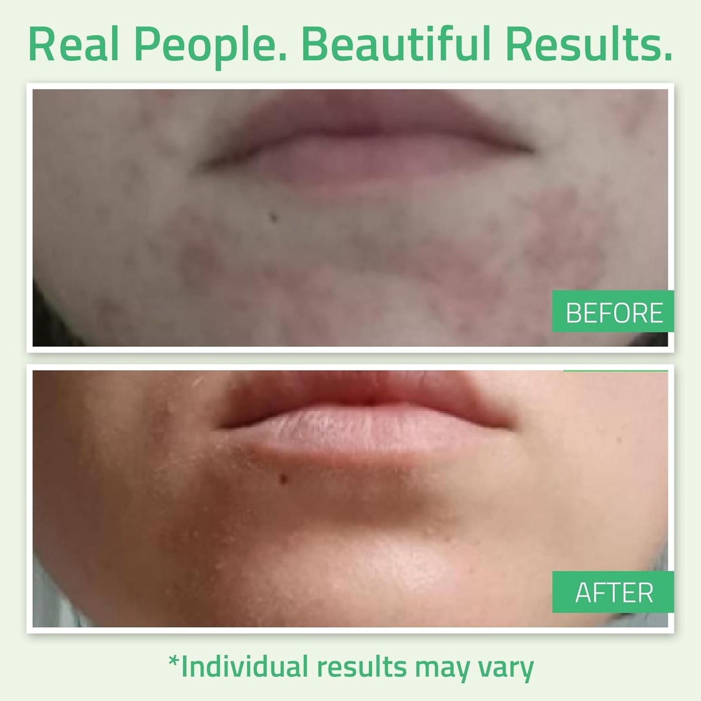 YEOUTH Glycolic Acid Peel - At-Home Chemical Exfoliator with 30% AHA & Retinol for Smooth Skin | 1oz