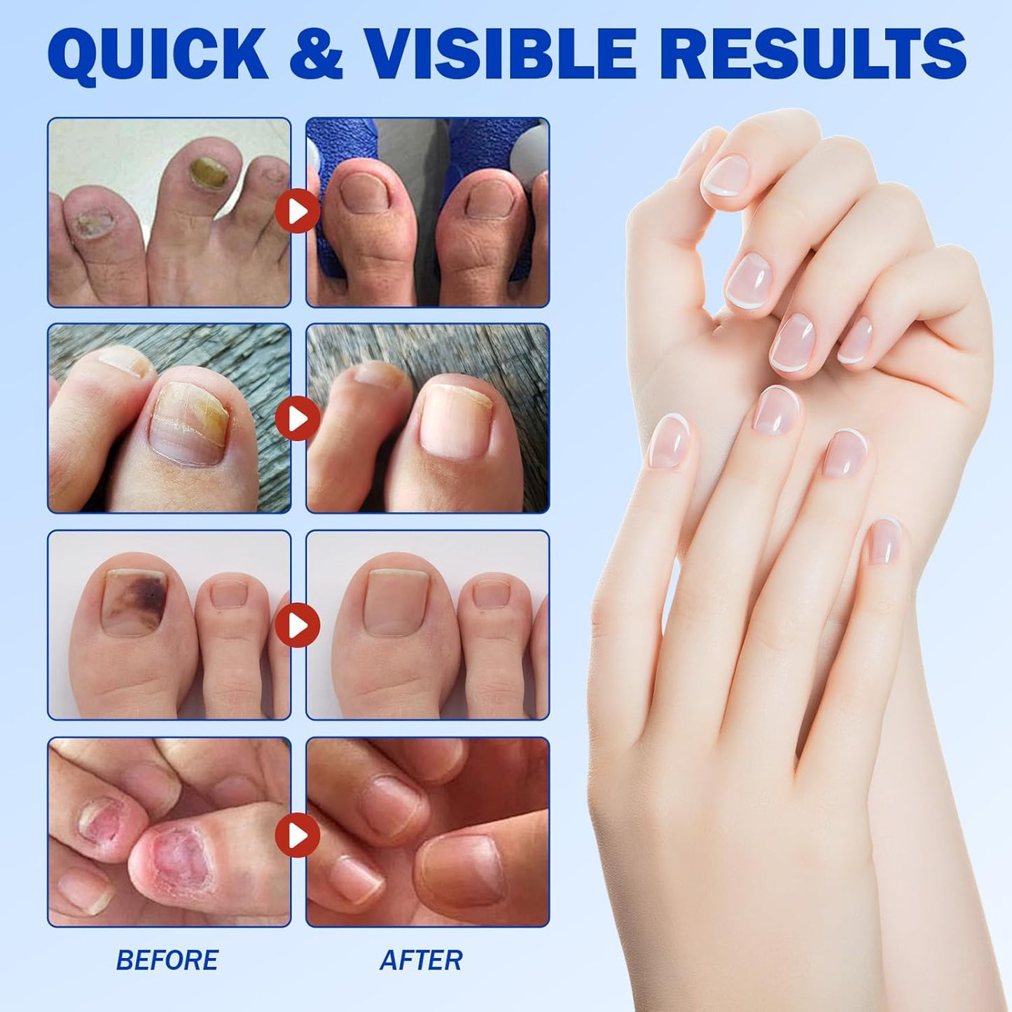Skiennix Fungal Nail Patches - Extra Strength 8-Hour Overnight Treatment | 42 PCS Hydrogel Care for Damaged Nails