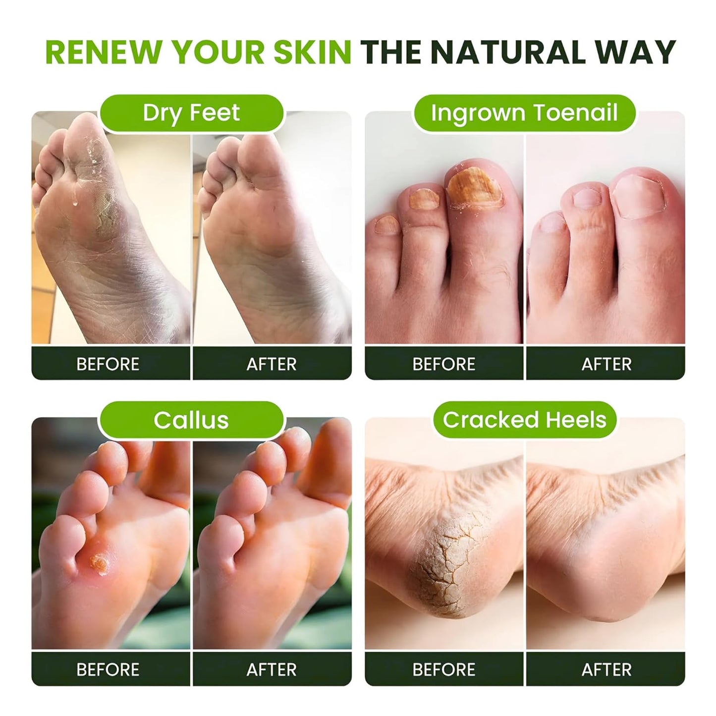 Tea Tree Oil Foot Soak by [Brand Name] - Epsom Salt Formula for Toenail Repair & Sore Feet Relief | 16 oz