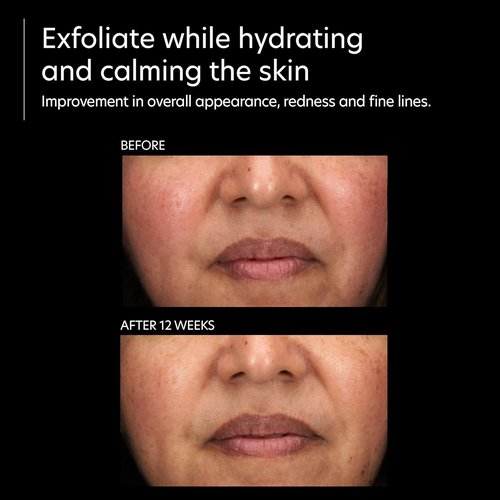 PCA SKIN Resurfacing Serum - Gentle Exfoliating Facial Treatment with Lactic & Glycolic Acid (1 fl oz)