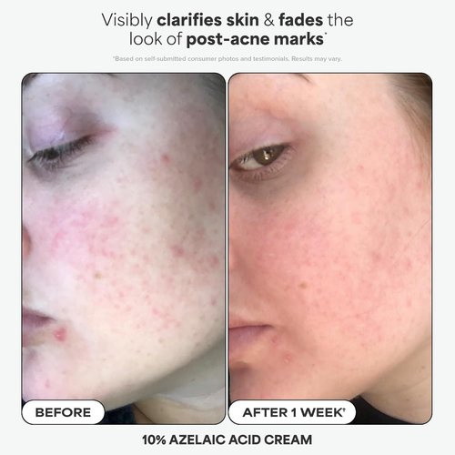 Paula's Choice Mini Skin Care Set - 4-Piece Kit with BHA Exfoliant, Retinol, Azelaic Acid & SPF 50