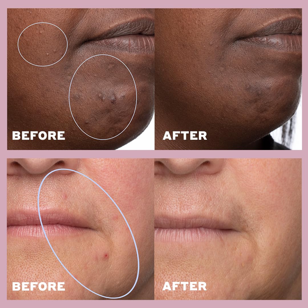 Volition Beauty Skin Rhythm Serum - Balancing Niacinamide & Salicylic Acid | Acne Treatment for Even Skin Tone & Dark Spot Reduction