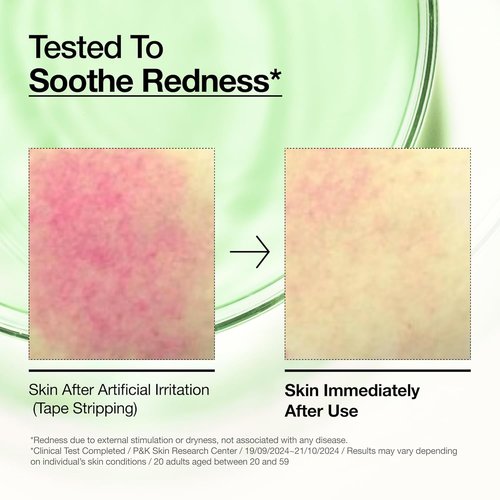 Anua Azelaic Acid 10% Serum - Redness Soothing Facial Serum for Blemish-Prone Skin | 1.01 fl oz
