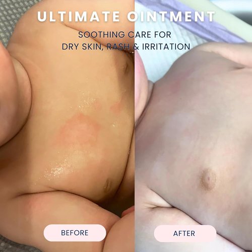 Noodle & Boo Ultimate Ointment for Babies – Multi-Purpose Skin Protectant for Eczema, Dry Skin, and Minor Irritations – Pediatrician-Tested, Gentle for Sensitive Skin