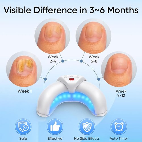 Regine Switzerland Toenail Repair Treatment - Effective Solution for Multiple Nails | Three Modes