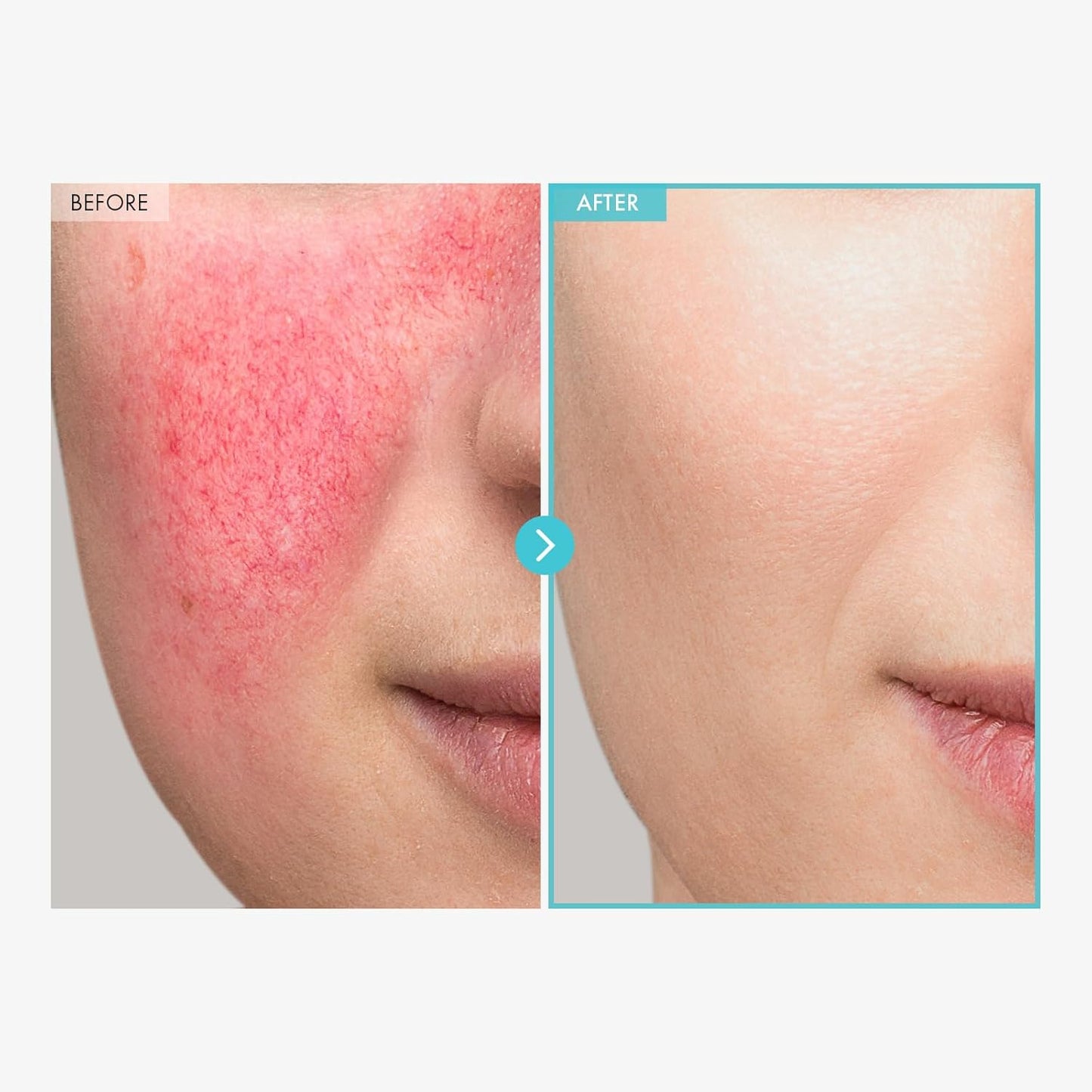 TOSOWOONG Zinc Oxide Cream - 100,000ppm Acne & Redness Relief | Non-Comedogenic, 50g (1.76 oz)