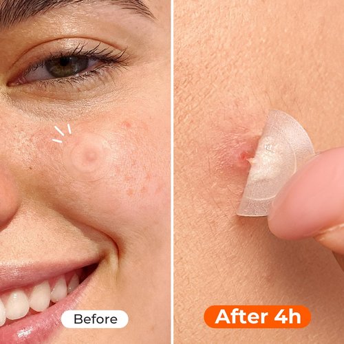 TKTK Pimple Patches, 12 mm Invisible Acne Patches for Face with Salicylic Acid, 0.01cm Extra Thin Outer Edge, Hydrocolloid Zit Patch for Pustule, Whitehead, Cystic Acne Spot, 48 Count