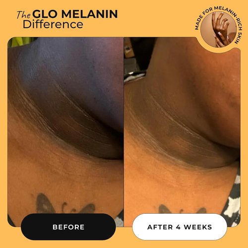 Glo Melanin Magic Eraser Dark Spot Cream - Fade Dark Spots on Face & Body, 1.7 Oz