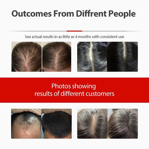 2026 Upgrade Laser Cap, Red Light Therapy for Hair Growth