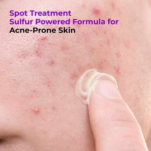 GLAM UP 10% Sulfur Treatment Spot Serum - Fast Healing for Pimples & Acne Breakouts | 15mL