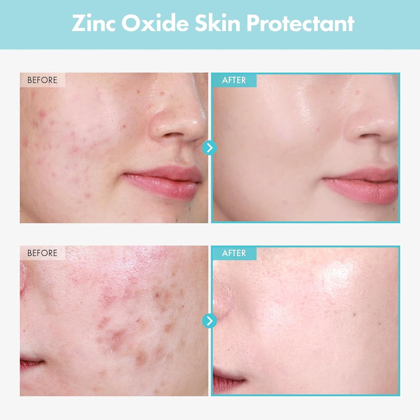 TOSOWOONG Zinc Oxide Cream - 100,000ppm Acne & Redness Relief | Non-Comedogenic, 50g (1.76 oz)