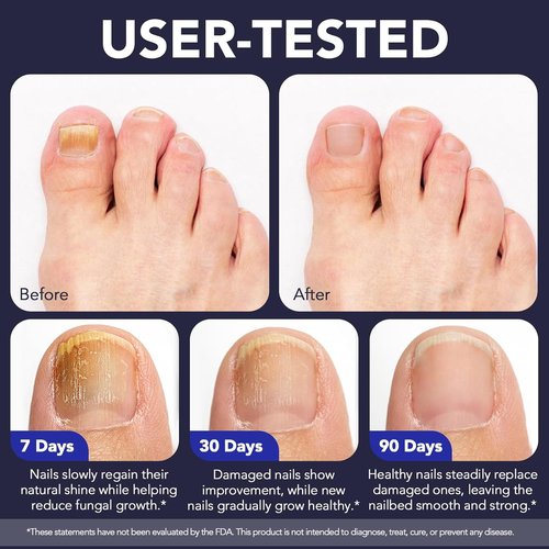 Regine Switzerland Toenail Fungus Pen - Extra Strength Treatment for Discolored Nails - 25% Undecylenic Acid with Tea Tree & Jojoba (0.1 Fl Oz, Pack of 5)