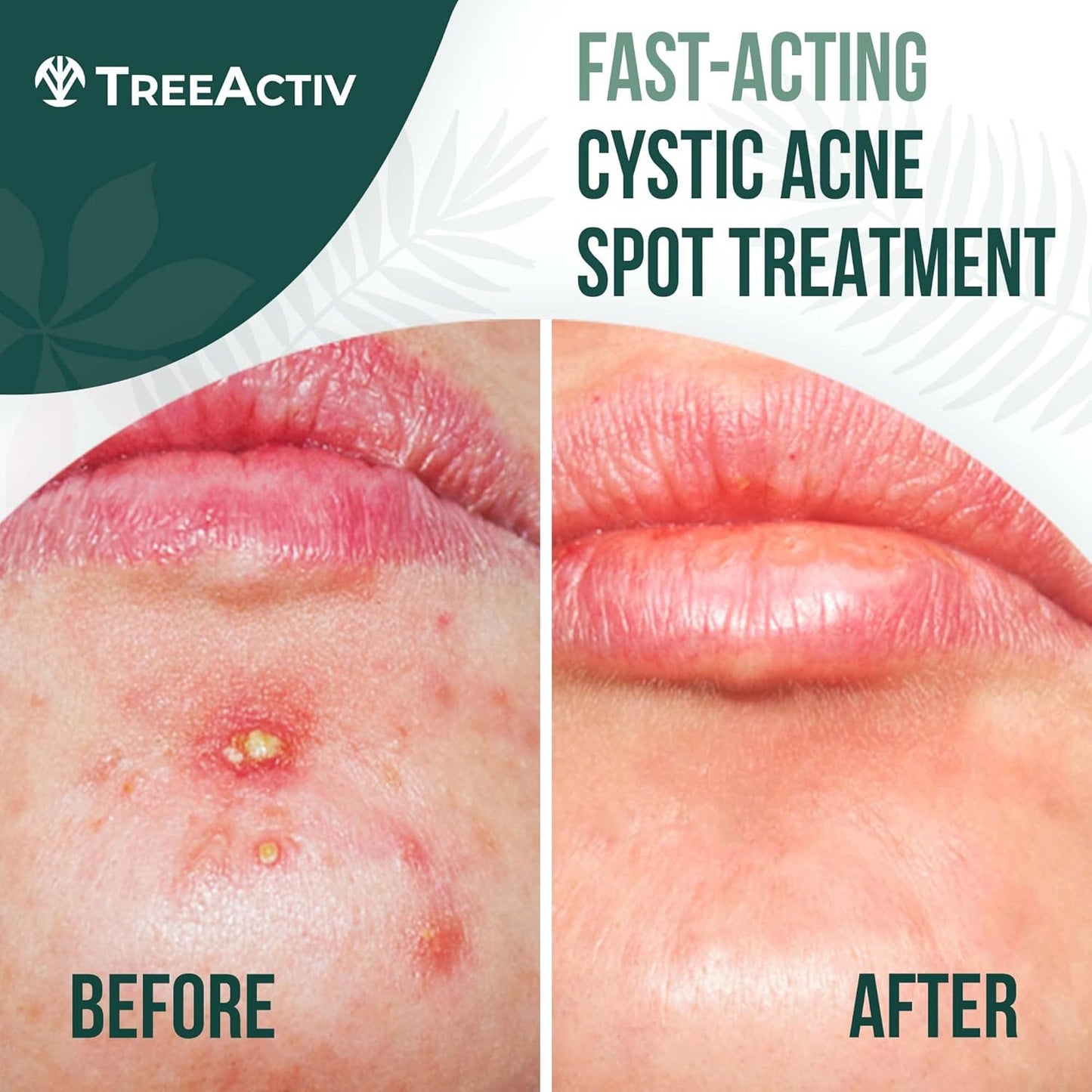 TreeActiv Cystic Acne Spot Treatment Paste - Sulfur & Tea Tree Oil for Deep Breakouts | 0.5 oz
