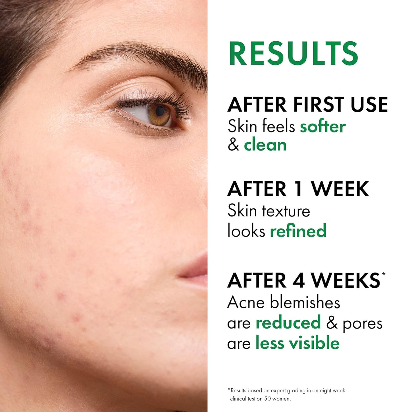 VICHY Normaderm Acne Control Moisturizer - Oil-Free Formula with 2% Salicylic Acid & Vitamin C | Targets Blemishes & Enlarged Pores