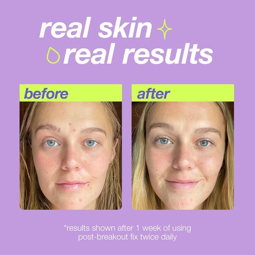Dermalogica Clear Start Acne Dark Spot Treatment - Salicylic Acid & Squalene for Fading Marks