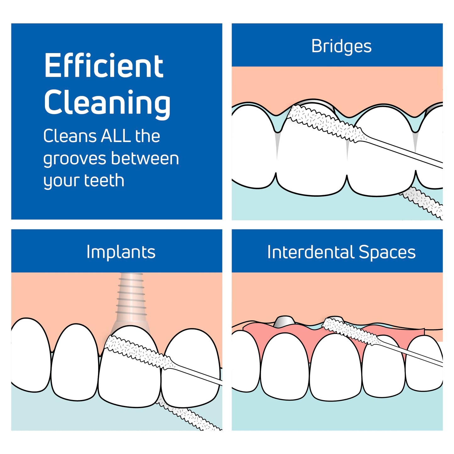 TePe Bridge and Implant Floss for Dental Implants, Bridges, and Braces, Dental Flossers, 30 Pieces