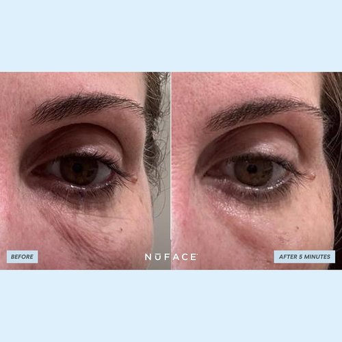 NuFACE IonPlex Hydra-Gel Under Eye Patches - Cooling Treatment for Puffy Eyes & Dark Circles (60 Count)