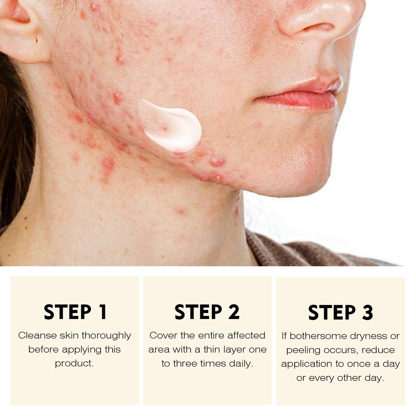 Acne Treatment for Face, Acne Cream Back Acne Treatment Cream for Teens & Adults Anti-acne Moisturizer Pimple Cream Butt Acne Clearing Cream, Acne Spot Treatment for Breakouts Blemish 30g