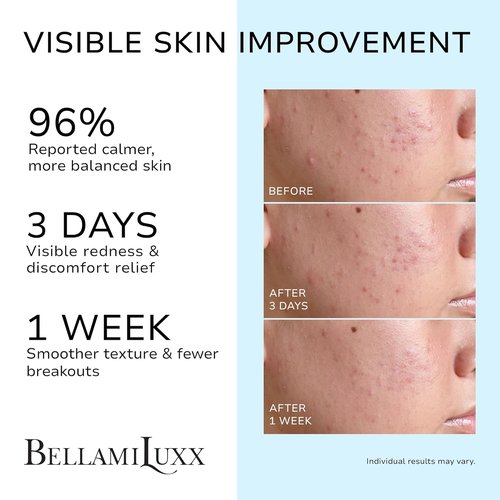 Cystic Acne Treatment for Face: Hormonal Acne Treatment Cream for Teens & Adults - Salicylic Acid & Tea Tree Oil Pimple Spot Remover - Anti-Acne Moisturizer Reduces Redness, Blemishes