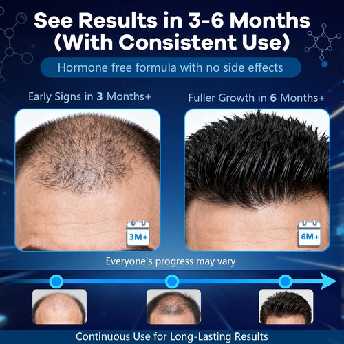5% Topical Minoxidil Foam, Aerosol Minoxidil for Men, Infused with Biotin, Hair Growth Treatment, Supports Thicker and Fuller Hair & Beard Unscented (Minoxidil Foam, 8.44oz, 4 Months Supply)