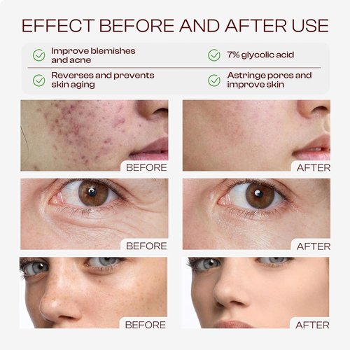 Glycolic Acid Toner - 240ml Exfoliating Toning Solution with 7% Glycolic Acid for Soothing Hydration