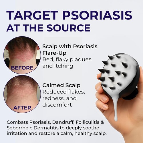 Psoriasis Shampoo - Medicated Anti-Dandruff Treatment for Flaky Scalp & Seborrheic Dermatitis - 200ml