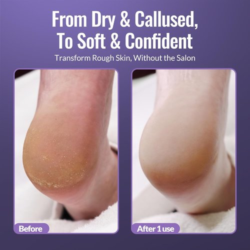 Footlogix Callus Softener Combo - Callus Remover Spray & Double-Sided Foot File for Dry, Cracked Heels