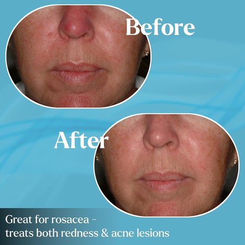 Pyratine A1 Soft Crème - Anti-Aging & Rosacea Treatment - Reduces Redness, Acne, & Fine Lines - 2 oz.