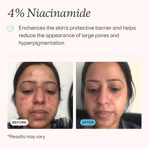 MDacne – Retinol 0.5% and Niacinamide 4% Cream, Reduces Blemishes and Improves Skin Texture without Irritation