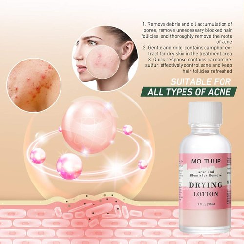 MO TULIP Acne Drying Lotion - Overnight Spot Treatment for Face & Body | 1 oz Pimple & Blemish Solution