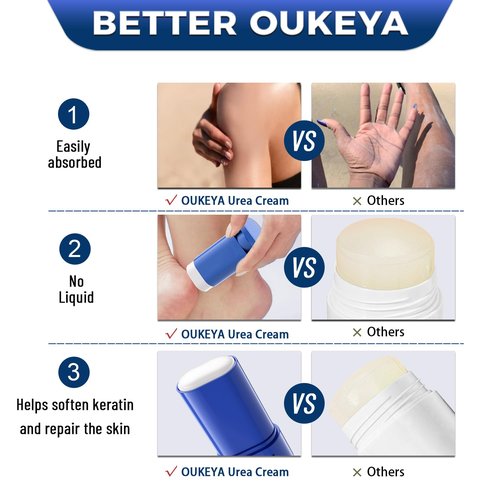 OUKEYA Urea Cream 40 Percent.Urea Cream Stick for Foot and Hand Cream Stick for Dry Cracked, Cracked Heel, Avoid Frostbite, 40 Percent Urea Lotion for Feet Maximum Strength, 2 PACK