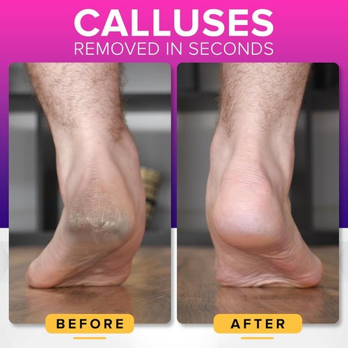 NYK1 Megafile Foot Callus Remover - Rustproof XL Size with Skin Catcher for Wet & Dry Use
