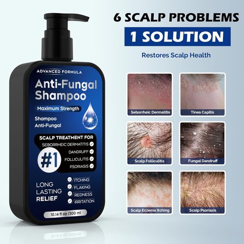 Regine Switzerland Antifungal Psoriasis Shampoo - Relieves Scalp Itching & Dryness | 10.1 Fl Oz