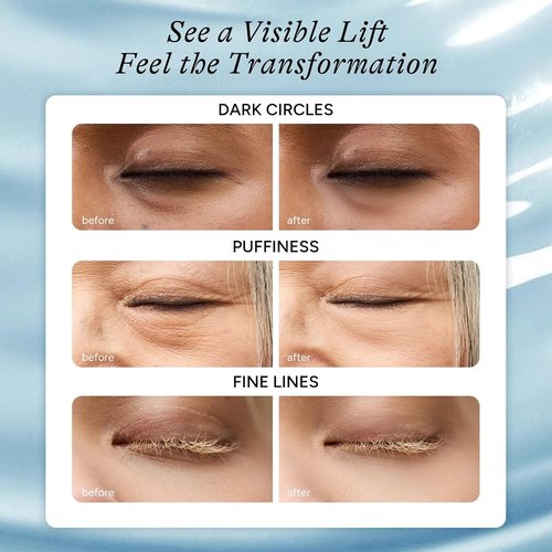 In My Eyes Hydrating Under Eye Patches - Hyaluronic Acid Hydrogel Masks for Dark Circles & Puffiness | 5 Pairs