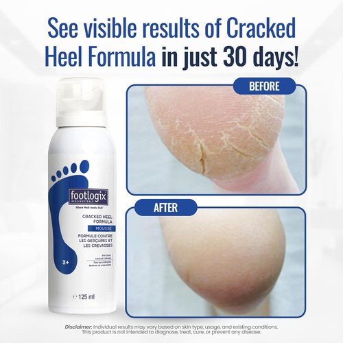 Footlogix Cracked Heel Formula - Repair Dry, Cracked Skin | 4.23 Ounce White Cream