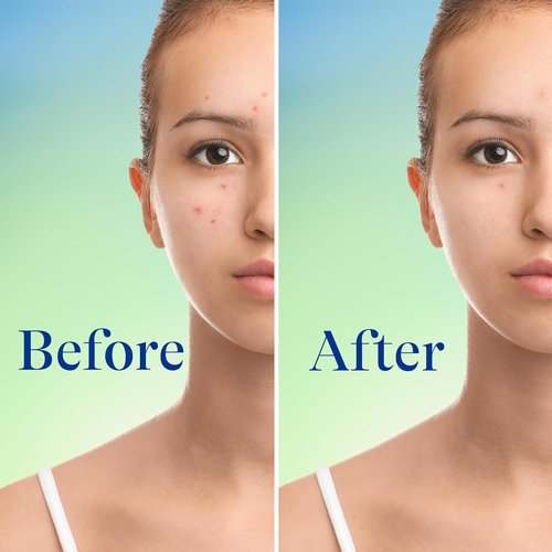 Differin Acne Face Wash - Maximum Strength 10% Benzoyl Peroxide Foaming Cleanser | 5 oz Fast-Acting Treatment