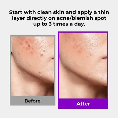 GLAM UP 10% Sulfur Treatment Spot Serum - Fast Healing for Pimples & Acne Breakouts | 15mL