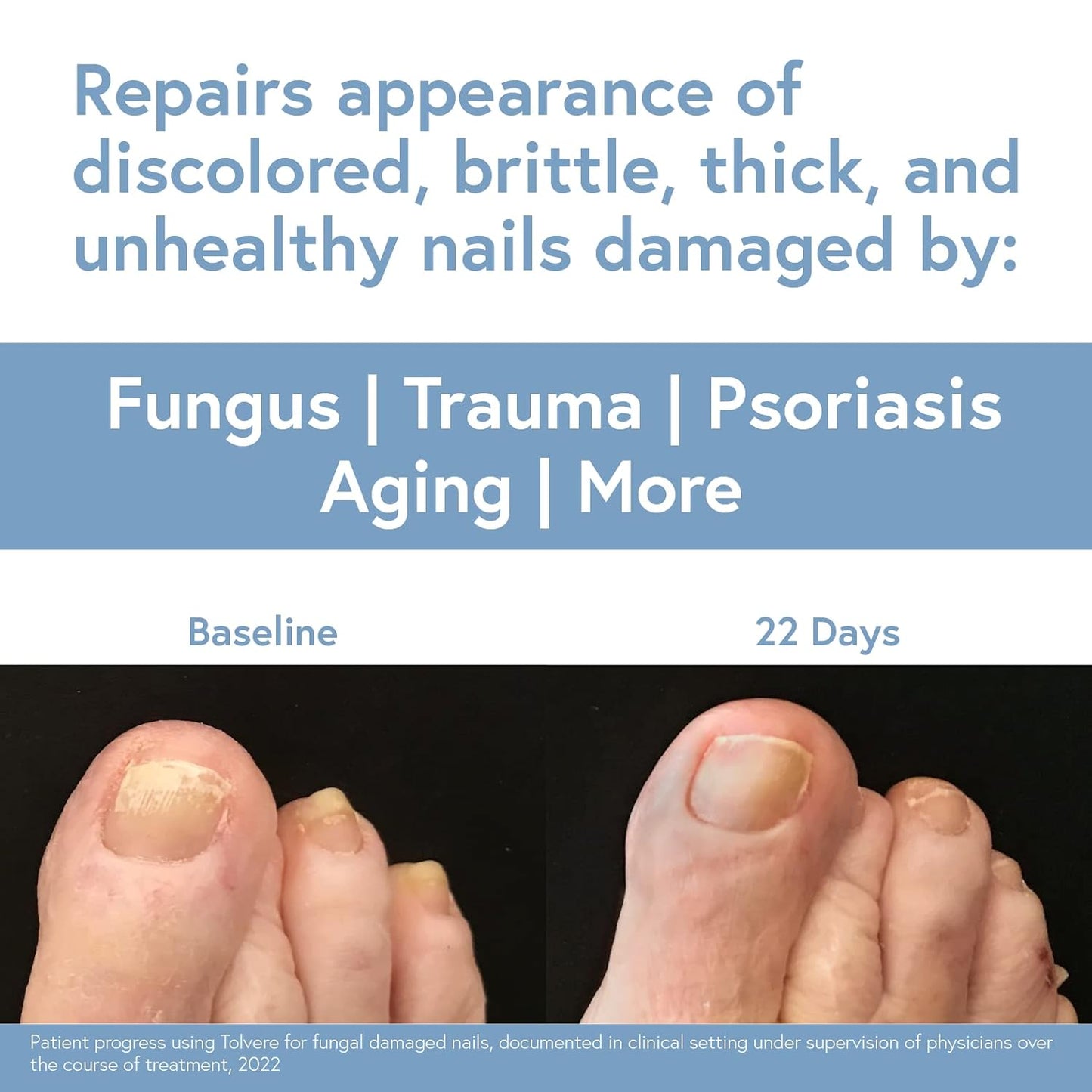 Tolvere Nail Renewal Solution - Revitalize Discolored, Brittle & Cracked Nails | Fast-Acting Treatment