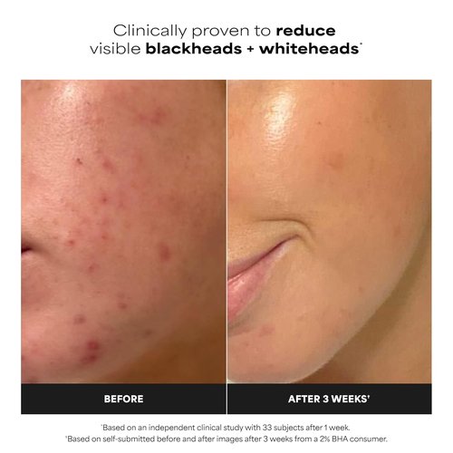 Paula's Choice SKIN PERFECTING 2% BHA Exfoliating Pads - Clear Blackheads & Minimize Pores
