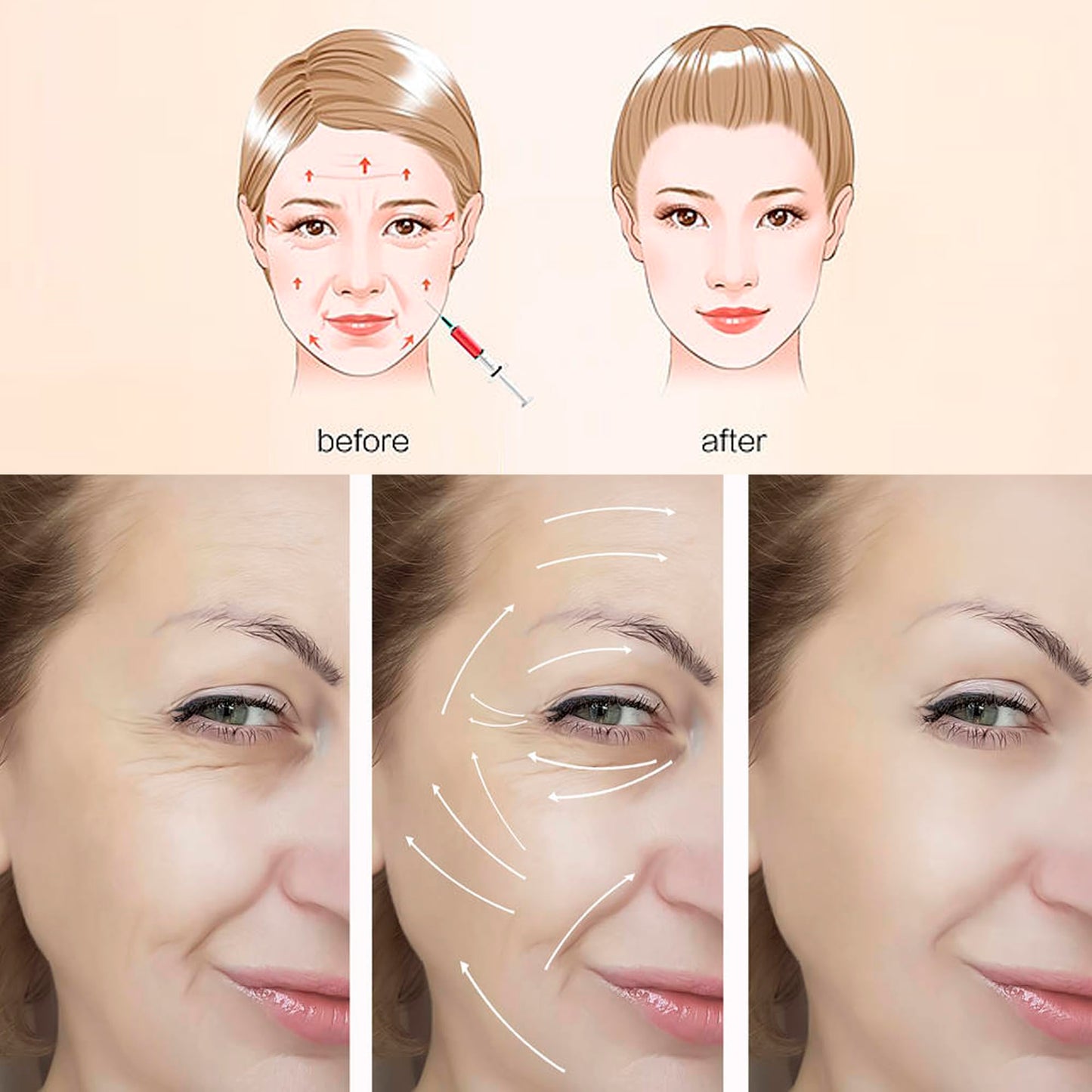 ESTEVO PDO Screw Thread, Improves Skin, Lift and Restore Skin Elasticity and Radiance, Pdo Thread Increase Firmness (20PCS-29G*38mm)