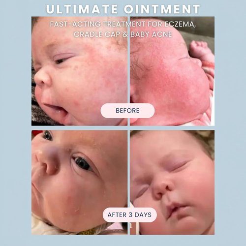 Noodle & Boo Ultimate Ointment for Babies – Multi-Purpose Skin Protectant for Eczema, Dry Skin, and Minor Irritations – Pediatrician-Tested, Gentle for Sensitive Skin