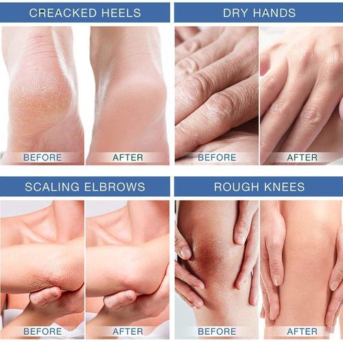 Rosarden Feet Cream for Dry Cracked Feet, 40% Urea Cream, Callus Remover Cream for Feet, Heels, Knees, Elbows, Hand, Moisturizing Foot Cream Softening Rough Skin On Feet, Rough Exfoliates Calloused