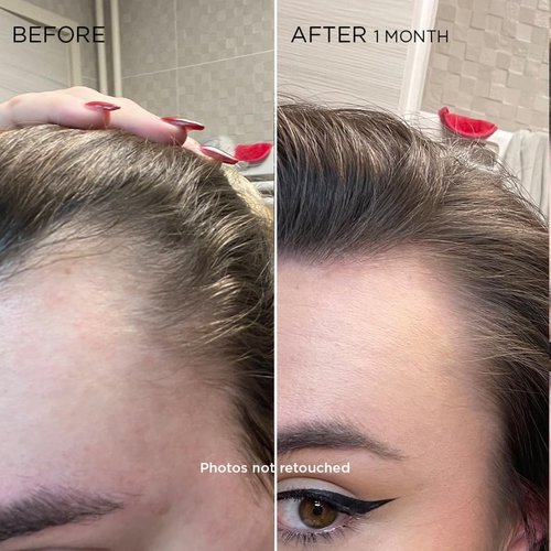 PhytoCyane Women's Hair Treatment - Combat Hair Thinning & Boost Volume | 6.7 Fl Oz