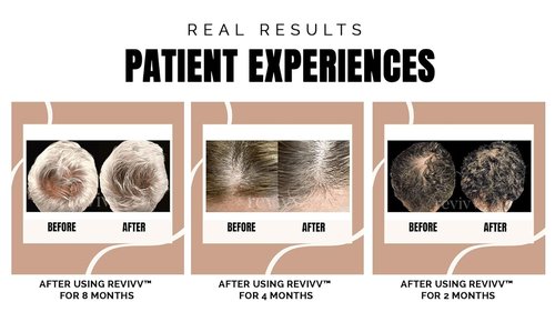 REVIVV Hair Growth Serum - 100% Natural Solution for Thicker, Fuller Hair | 1oz Bottle, 45-Day Supply